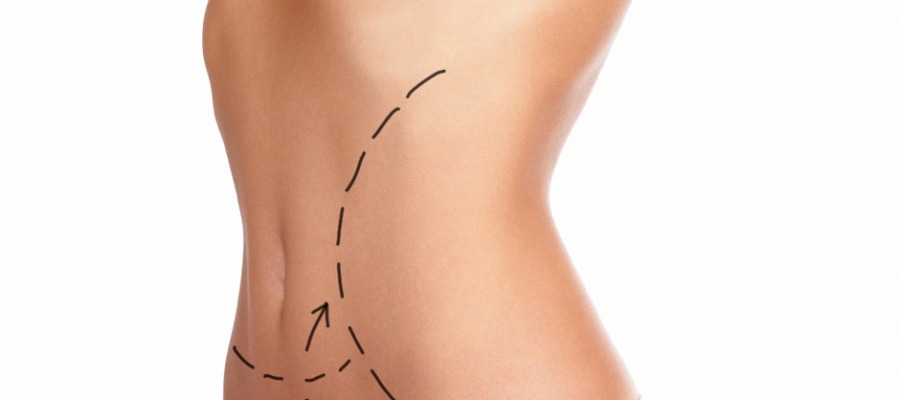Abdominoplasty - the tummy tuck