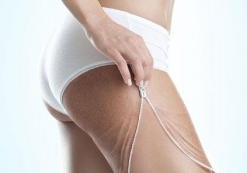 Advanced beauty technologies: cellulite has lost immortality